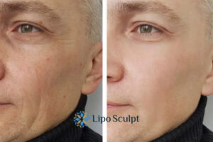 How to Fight Aging Symptoms 3 Fight Aging Symptoms Underwood With HIFU and Morpheus8 Today!