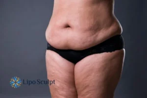 Cellulite's 5 Most Common Causes 4 Feel more confidence with your cellulite Underwood treatment today!