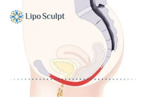 Pelvic Floor Chair Therapy 1 Pelvic Floor Chair Therapy Underwood to treat incontinence.