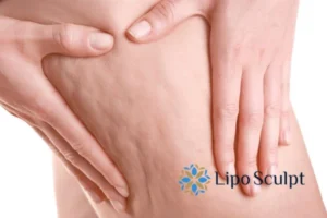 CoolSculpting for Legs: The Innovative Approach to Redefining Your Legs 5 Start your journey today book your coolsculpting treatment Underwood online today!