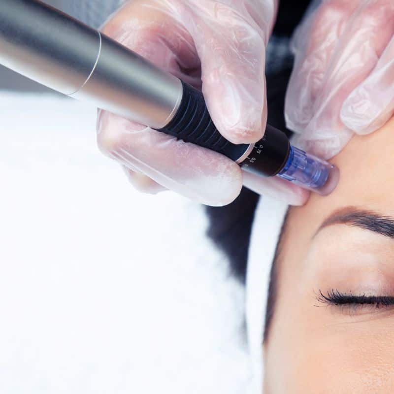 Morpheus8 treatment Underwood from Lipo Sculpt - Book in today!
