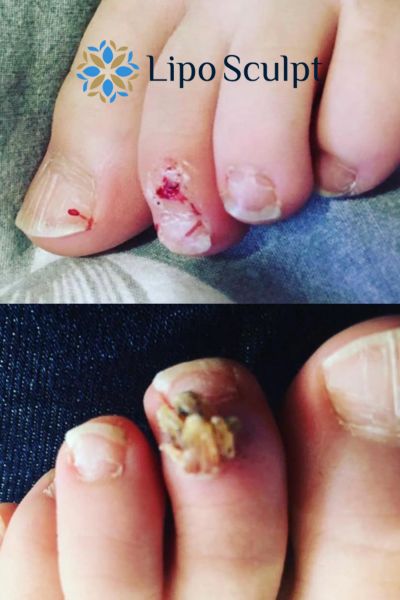 Wart removal customer results from Lipo Sculpt Underwood