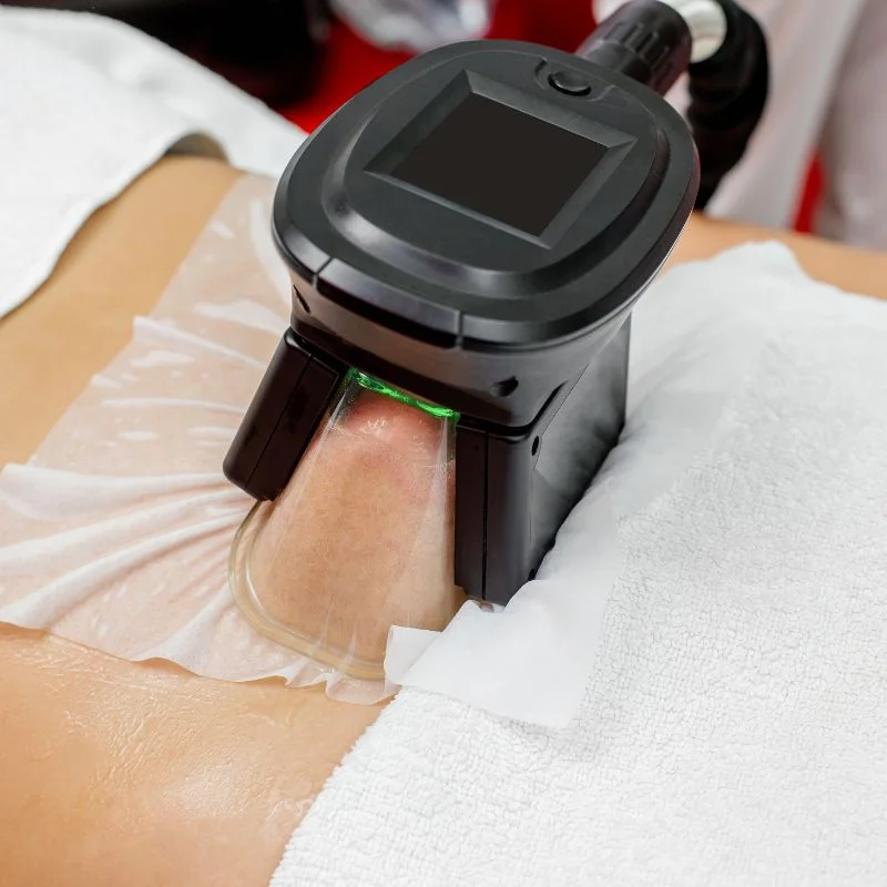 Fat Freezing treatment Underwood